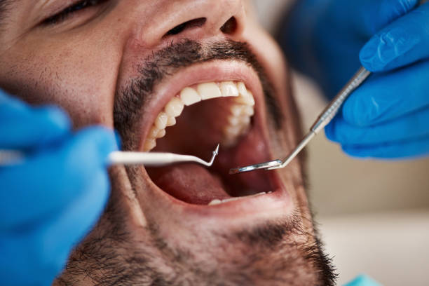 Teeth Whitening in ID