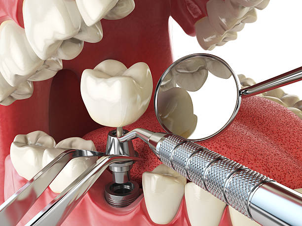 Best Chipped Tooth Repair Near Me  in Fruitland, ID